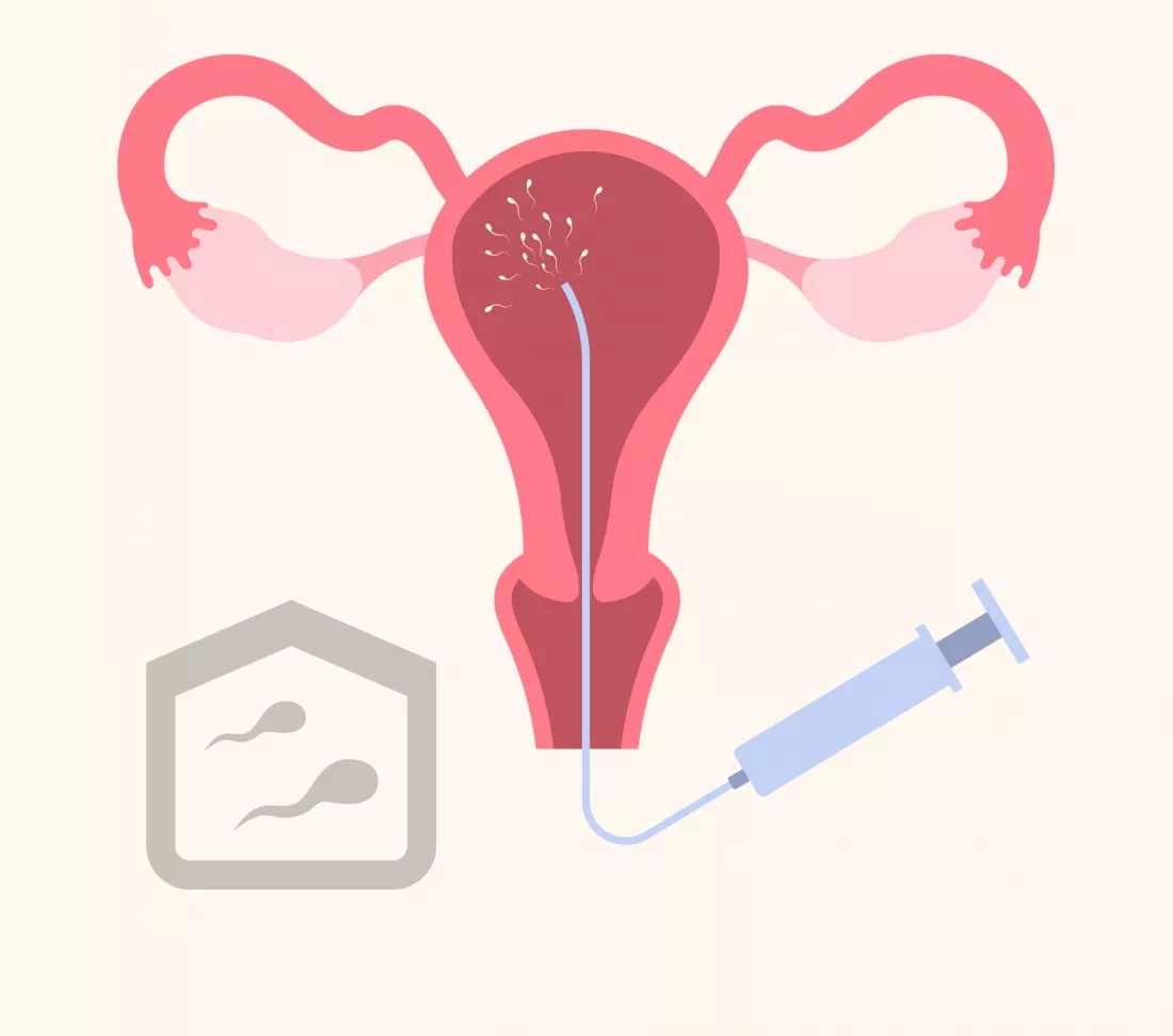top-8-advantages-of-intrauterine-insemination-iui-in-fertility-care